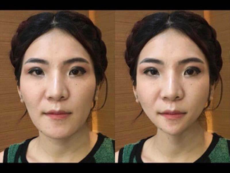 คนไทย ศัลยกรรมโครงหน้า