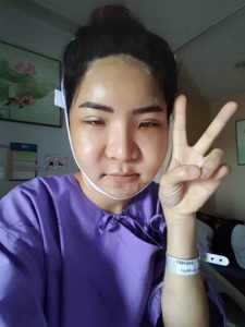 วันแรกหลังการผ่าตัด โครงหน้า