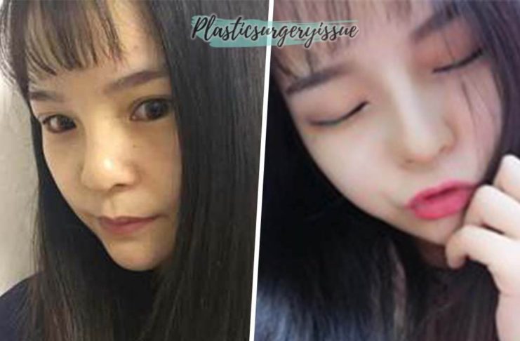 รีวิวศัลยกรรมเกาหลี-น้องแนน-จมูกที่เกาหลี
