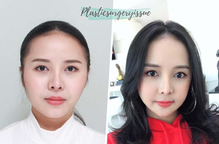 รีวิว ยุบโหนกแก้ไขหน้าเบี้ยว