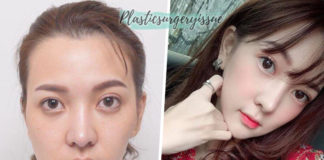 รีวิวประสบการณ์ตัดกรามเกาหลี