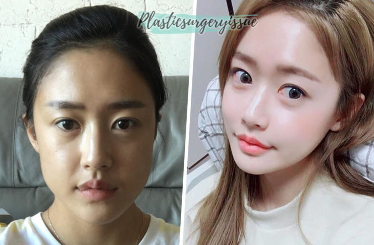 รีวิวศัลยกรรมแก้ไขหน้ายาว รีวิวหลังศัลยกรรม 7 เดือน