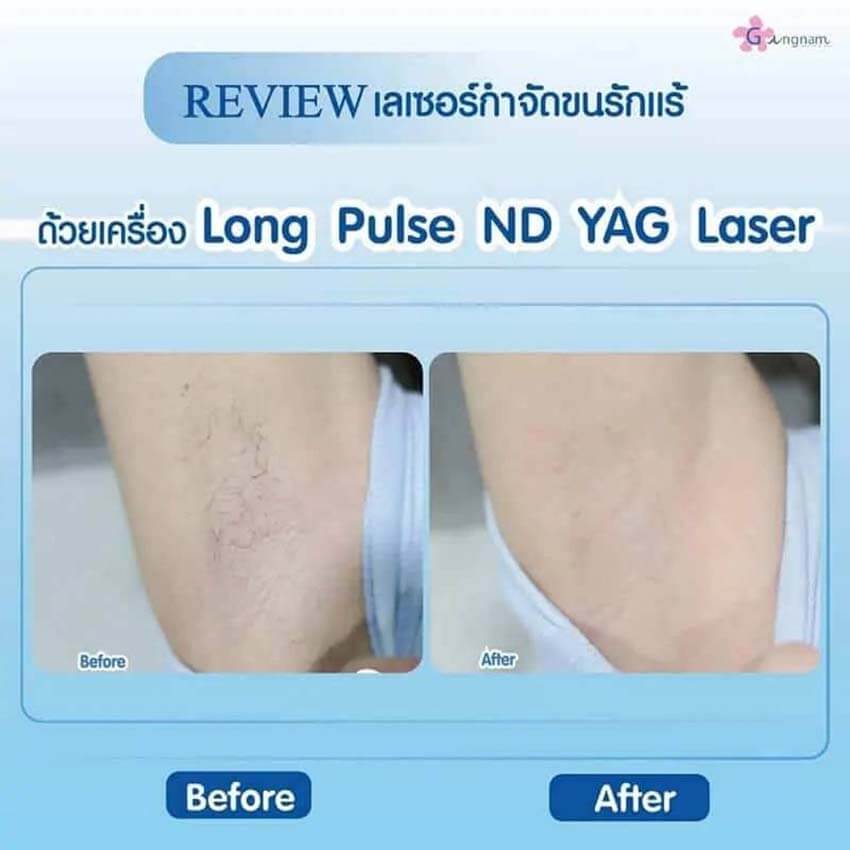 รีวิวหลังทำ เลเซอร์ขนรักแร้