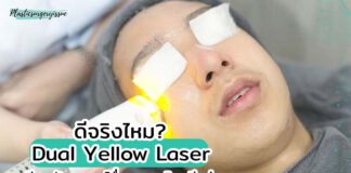 Dual Yellow Laser ช่วยให้หน้าใสจริงไหม