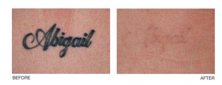 หลังลบรอยสักด้วยเลเซอร์ เป็นแผลเป็นไหม