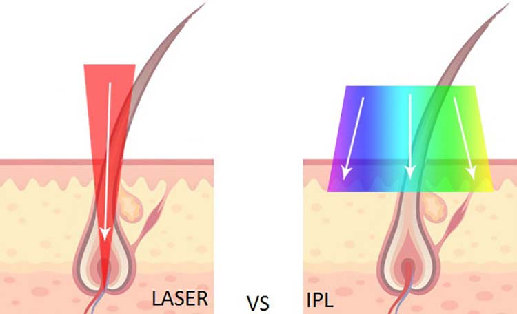 เปรียบเทียบ laser กับ ipl