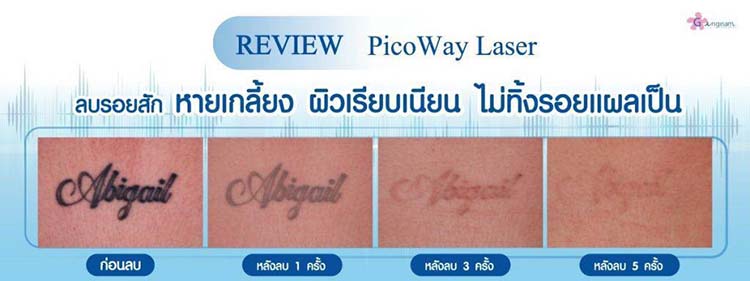 เลเซอร์ลบรอยสัก กี่ครั้งถึงเห็นผล