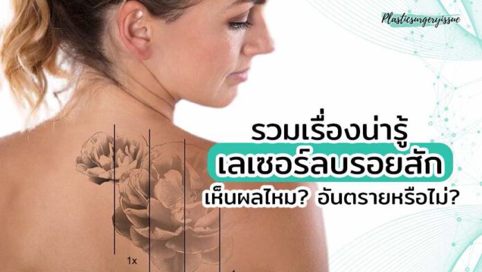 เลเซอร์ลบรอยสัก ทำแล้วเห็นผลไหม เลเซอร์ลบรอยสัก ทำแล้วเห็นผลไหม