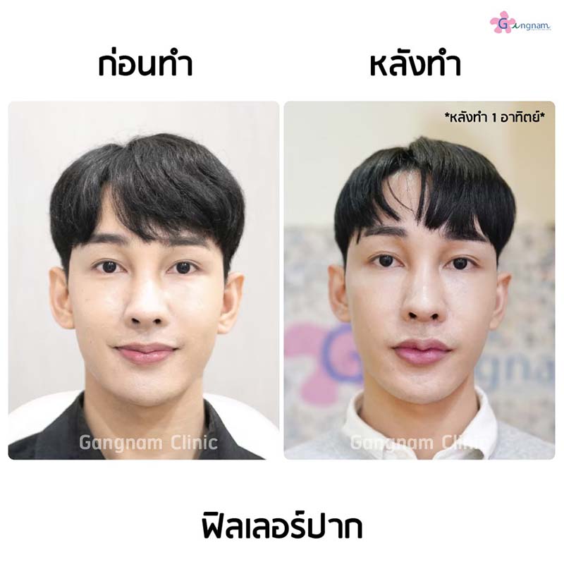 ฉีดฟิลเลอร์ปากเติมความชุ่มชื้นให้ปาก