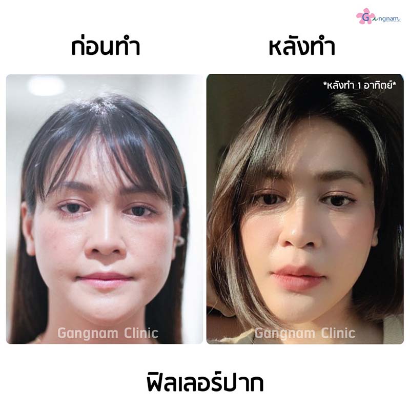 ฉีดฟิลเลอร์เสริมขอบปากให้ชัดขึ้น
