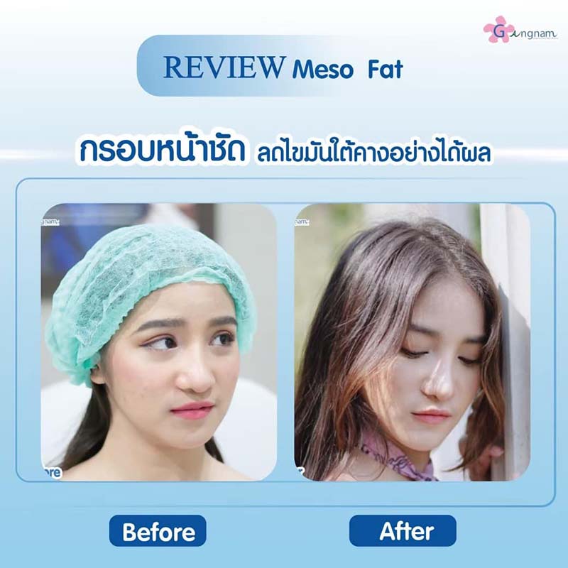ฉีดเมโสแฟตลดไขมันใต้คาง