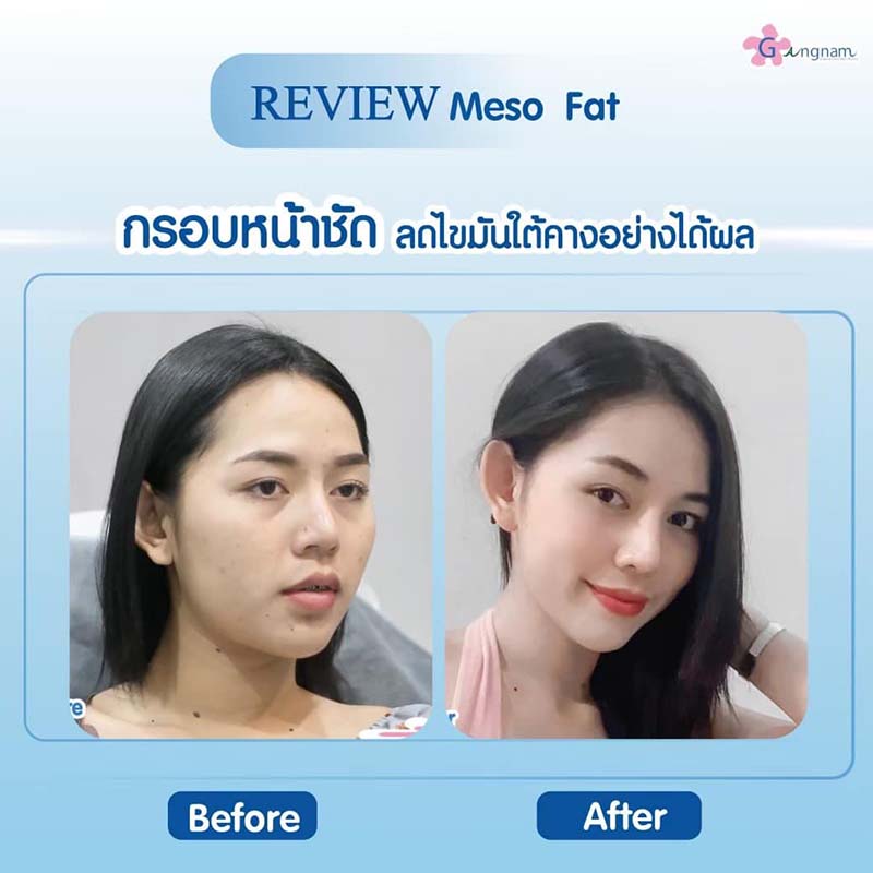 ฉีดเมโสแฟตเพื่อให้กรอบหน้าชัดขึ้น