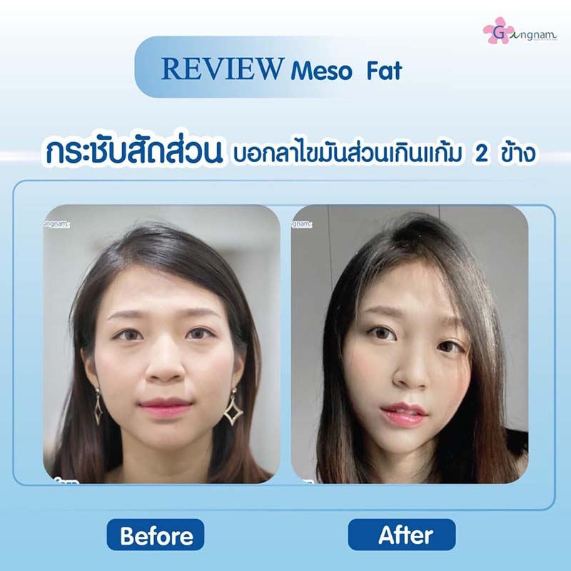 เมโสแฟตลดไขมันส่วนเกินแก้ม