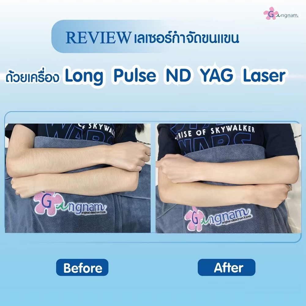 เลเซอร์กำจัดขนแขนที่คลินิก