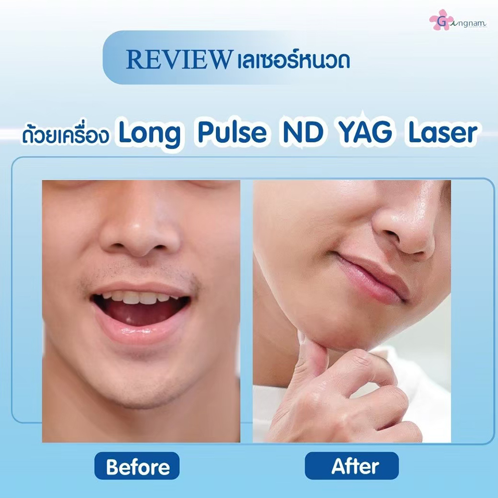 เลเซอร์หนวดที่คลินิก