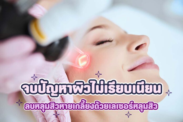 จบปัญหาผิวไม่เรียบเนียน ด้วยเลเซอร์หลุมสิว